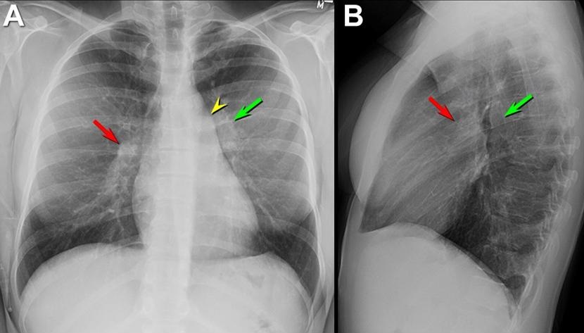 6-pulmonary-artery-and-vein-radiology-key