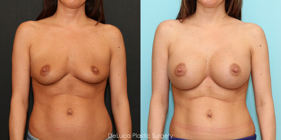 Breast Augmentation (475cc Implant - silicone). 