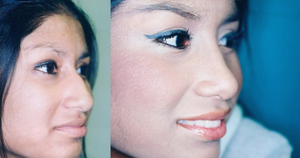 definition of plastic surgery Plastic surgery is a surgical specialty involving the restoration, reconstruction, or alteration of the human body it can be divided into two categories the first is reconstructive surgery which includes craniofacial surgery, hand surgery, microsurgery, and the treatment of burns. definition of plastic surgery Plastic surgery is a surgical specialty involving the restoration, reconstruction, or alteration of the human body it can be divided into two categories the first is reconstructive surgery which includes craniofacial surgery, hand surgery, microsurgery, and the treatment of burns.